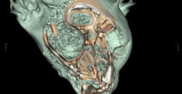 tomografia computorizada